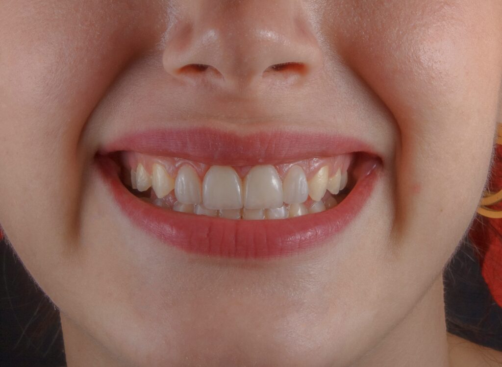 tooth stains