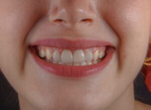 tooth stains